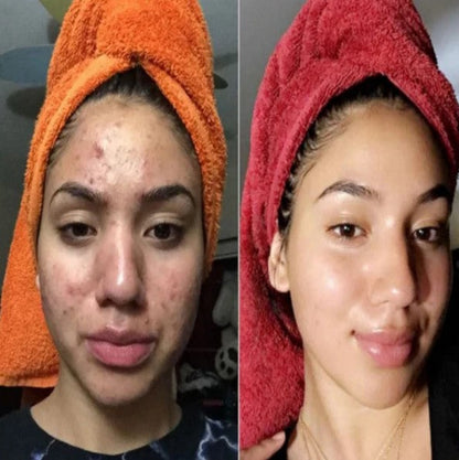 Exfoliante Anti-Imperfecciones Dr.Melaxín