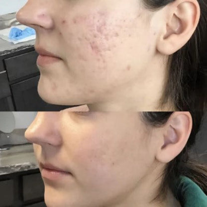 Exfoliante Anti-Imperfecciones Dr.Melaxín